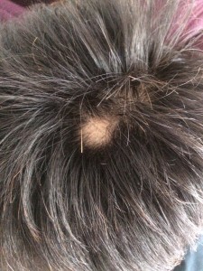 衝撃！ハゲていることが発覚！ハゲになって初めてわかった5つのこと